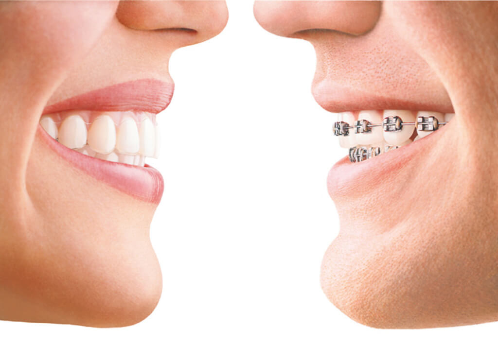 Alternative to Braces