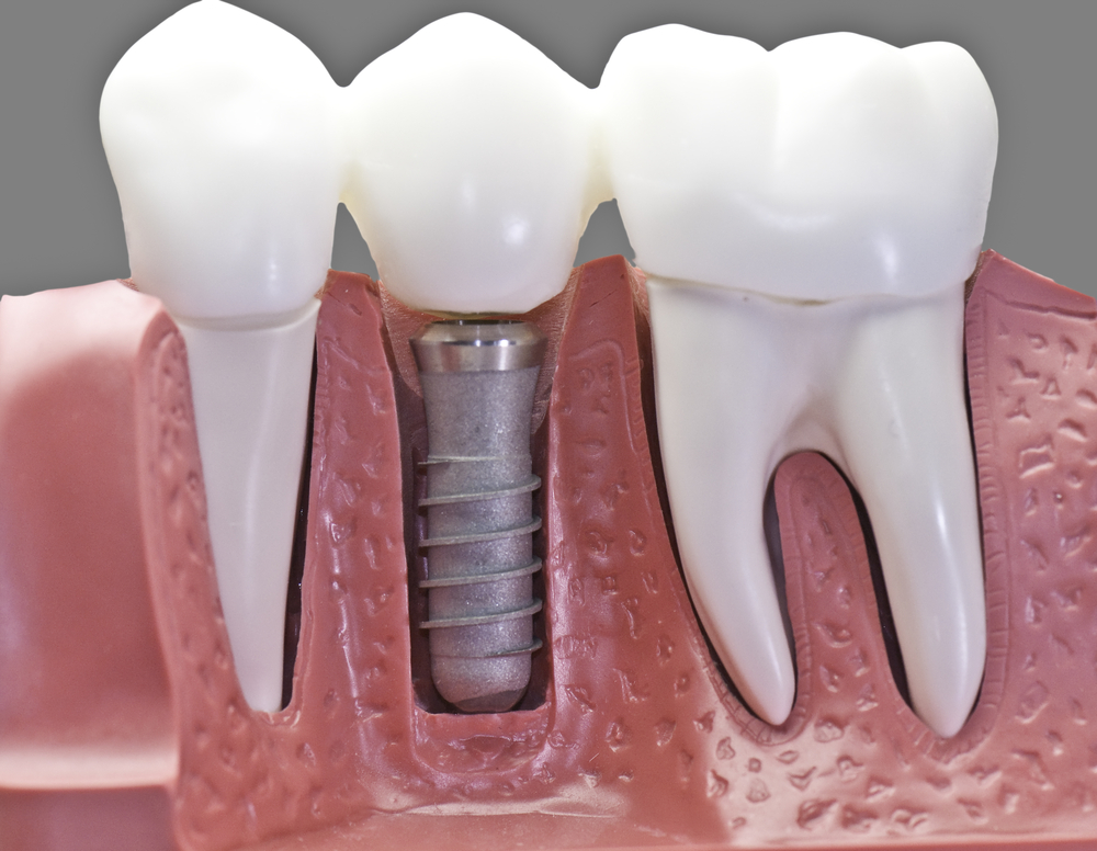 Dental implants